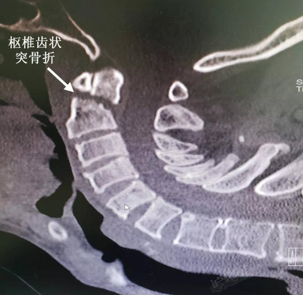 齿状突骨折脱位